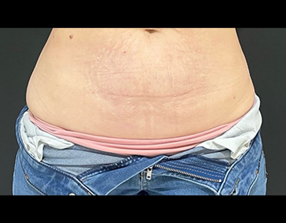 Lower abdomen skin tightening after HIFU treatment