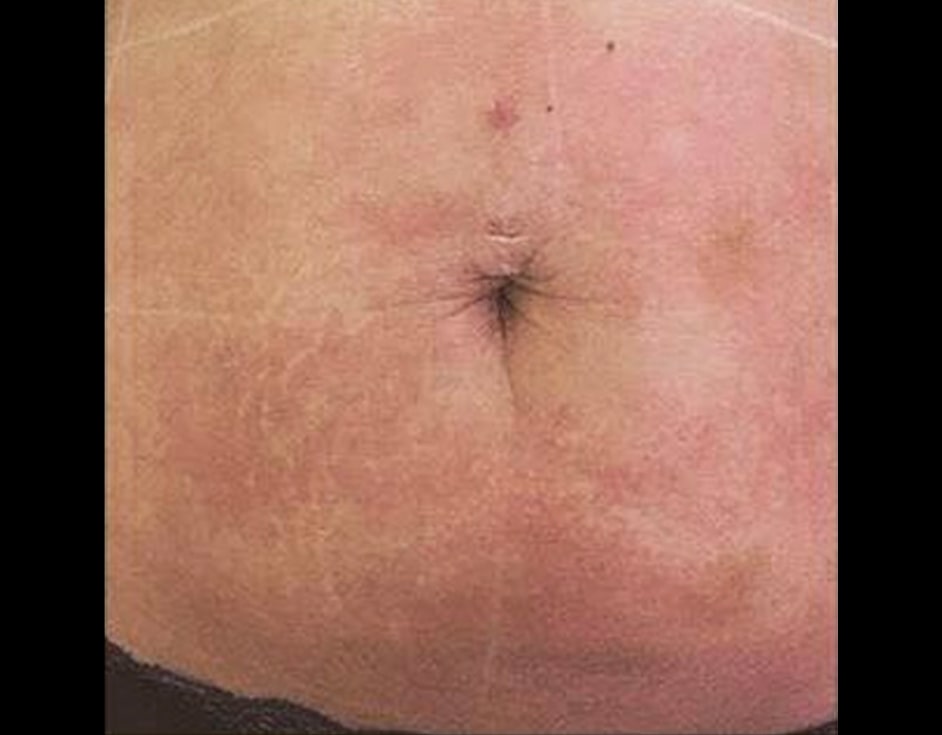 Lower abdomen contouring after HIFU treatment