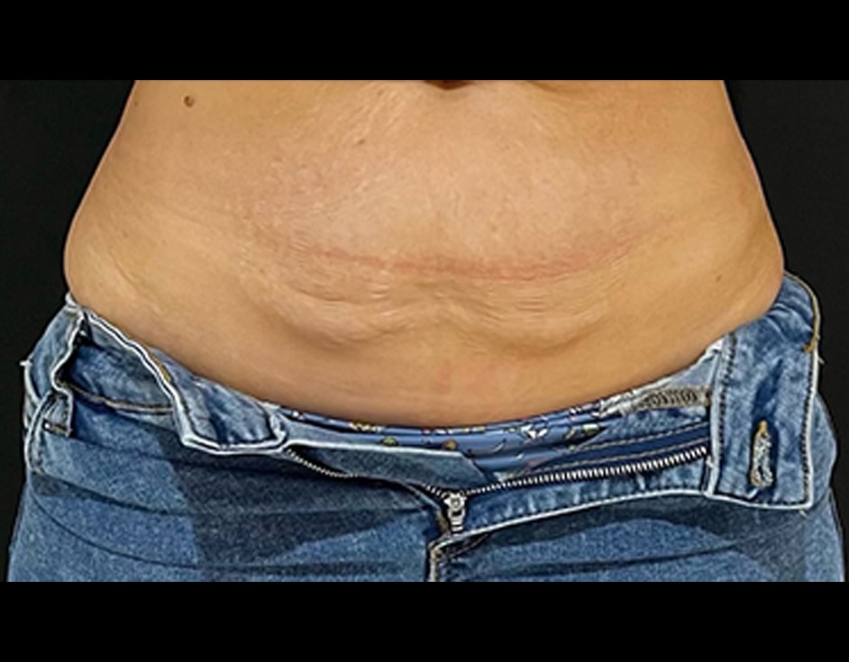 Lower abdomen skin tightening before HIFU treatment