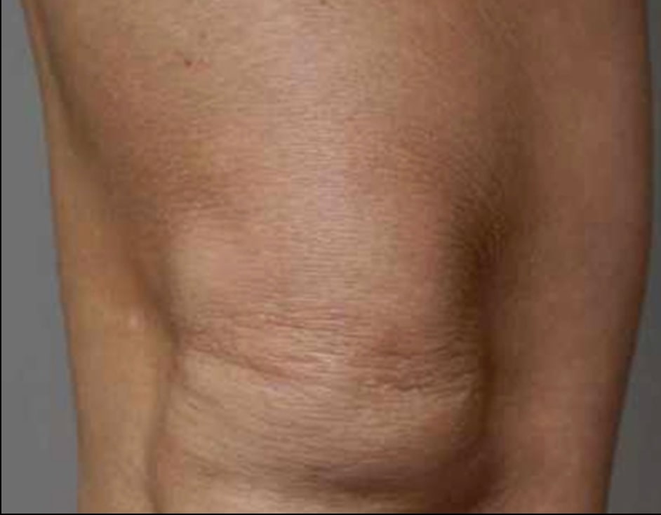 Knees skin tightening after HIFU treatment