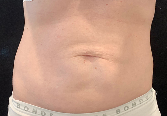 Abdomen lift & tighten after HIFU treatment