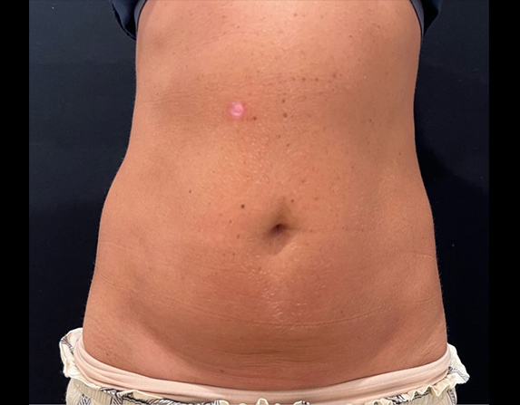 Abdomen lift & tone after HIFU treatment