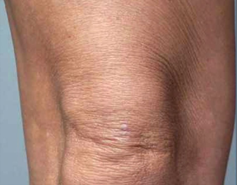 Knees skin tightening before HIFU treatment