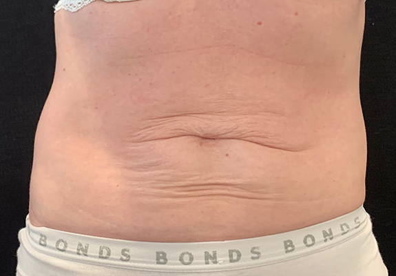 Abdomen lift & tighten before HIFU treatment