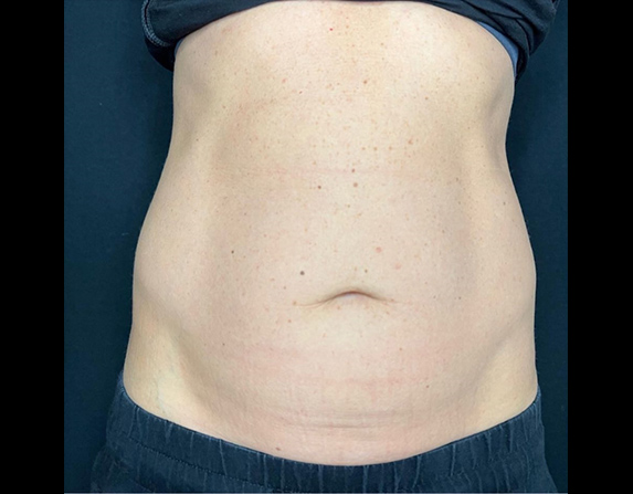 Abdomen lift & tone before HIFU treatment