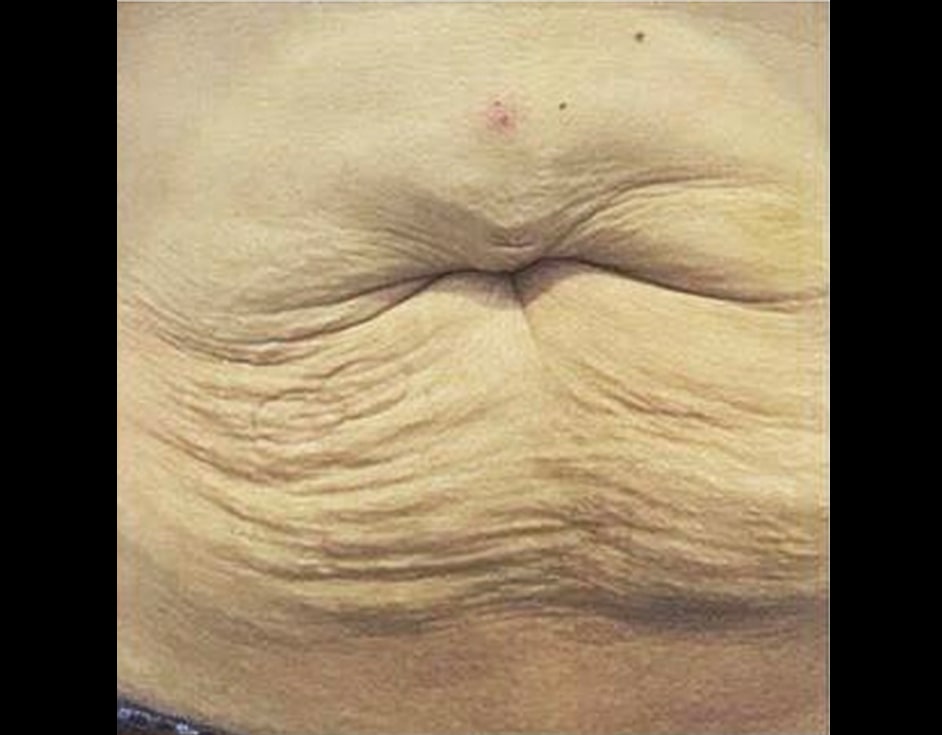 Lower abdomen contouring before HIFU treatment