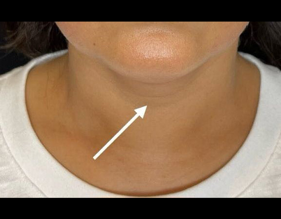 Double chin reduction after HIFU treatment