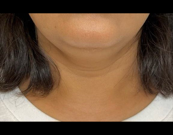 Double chin reduction before HIFU treatment