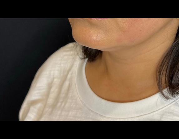 Double chin reduction after HIFU treatment