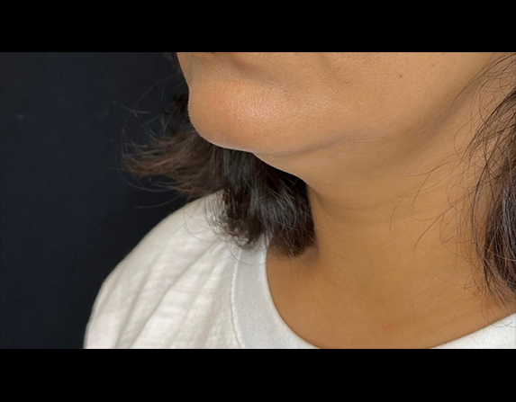 Double chin reduction before HIFU treatment