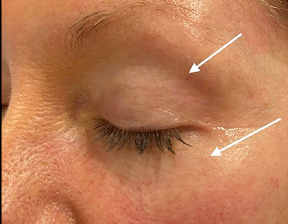 Fox eye lateral brow lift after HIFU treatment