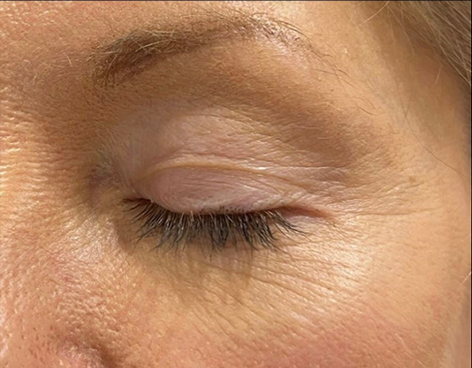 Fox eye lateral brow lift before HIFU treatment