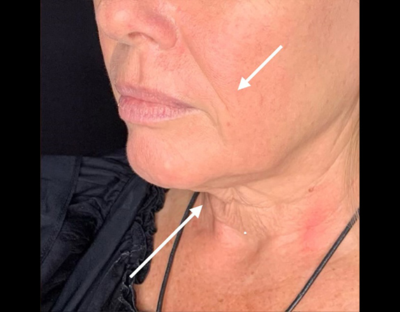 Lower face lift / double chin reduction after HIFU treatment