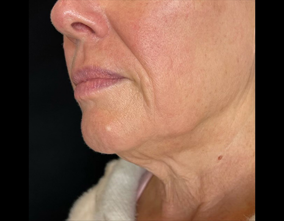Lower face lift / double chin reduction before HIFU treatment