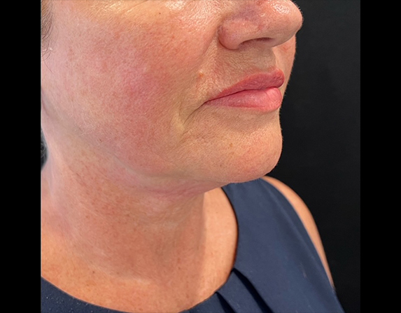 Lower face lift / double chin reduction after HIFU treatment