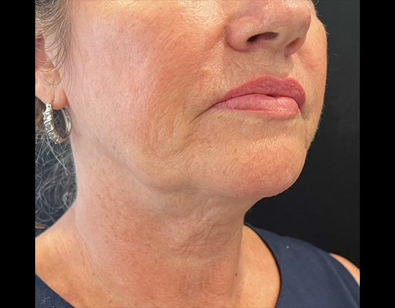 Lower face lift / double chin reduction before HIFU treatment